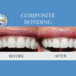 dental bonding