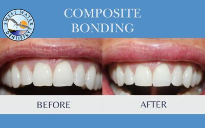 Composite Bonding for a Chipped Front Tooth