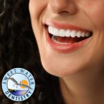 dental veneers