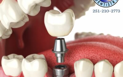 Do You Get Temporary Teeth While Waiting For Implants?