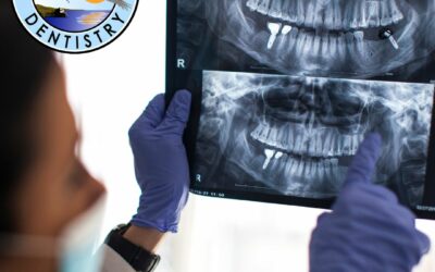 Which Location In The Mouth Has The Highest Failure Rate For Dental Implant?