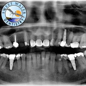 Dental Implants