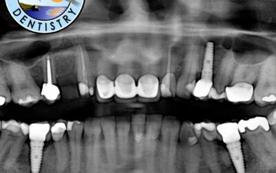 How To Prove Dental Implants Are Medically Necessary?