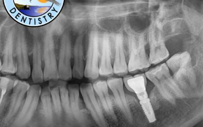 How Long Does The First Step Of A Dental Implant Take?