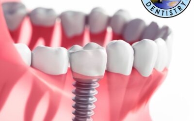 How Much Does It Cost To Get An Implant In The US With Insurance?