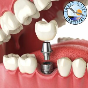 Do You Get Temporary Teeth While Waiting For Implants?