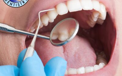 Can a Crown Be Replaced if It Gets Damaged? Everything You Need to Know